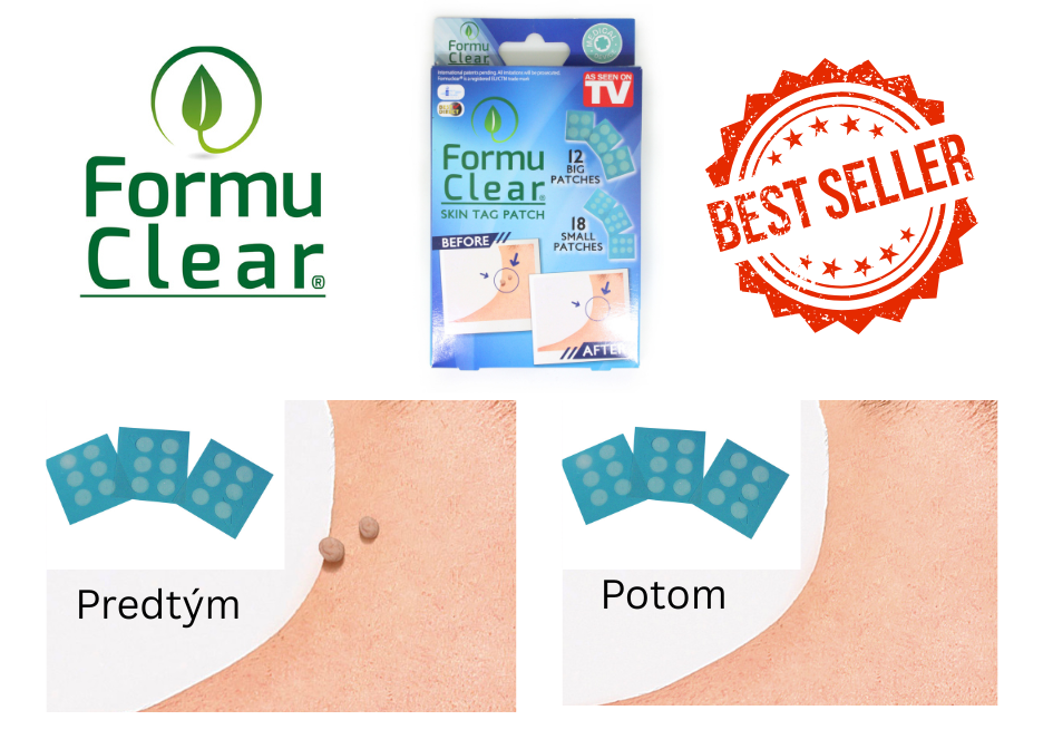 Formu-Clear-naplasti-na-odstranovanie-koznych-vyrastkov