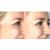 Tara crows feet B&A AC